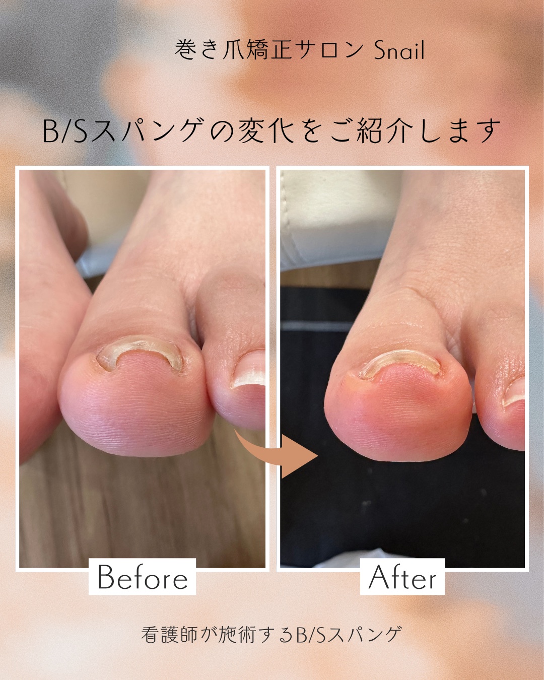 巻き爪矯正 施術例 ビフォーアフター