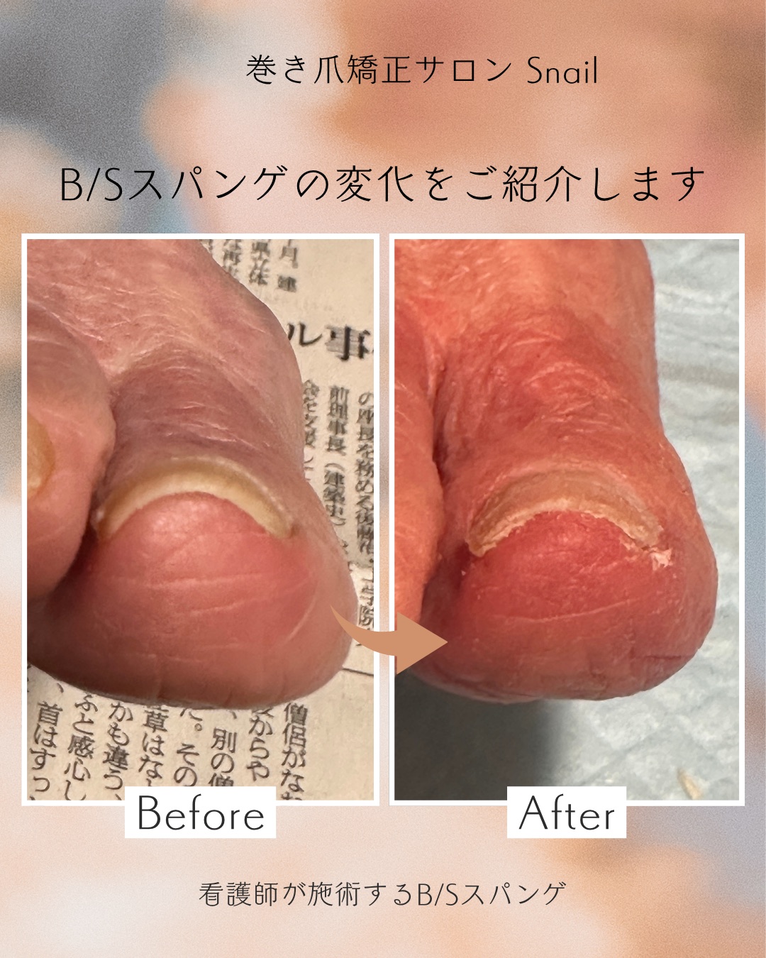 巻き爪矯正 施術例 ビフォーアフター
