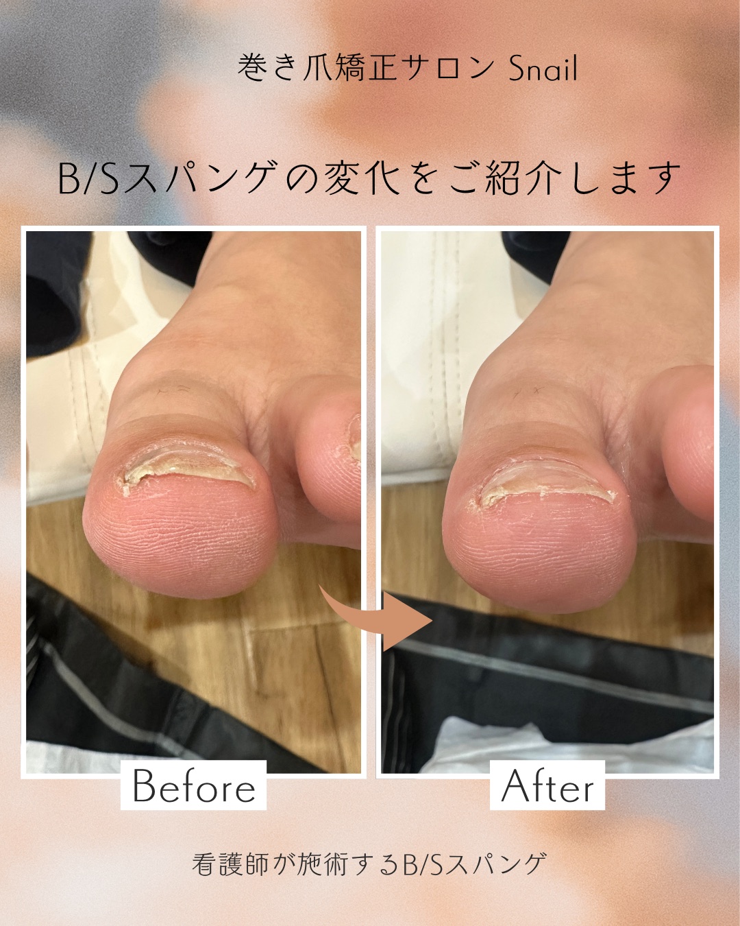 巻き爪矯正 施術例 ビフォーアフター